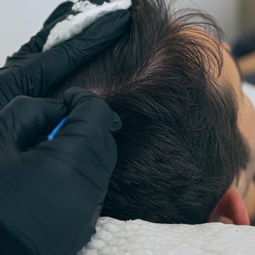 trichopigmentation greffe cheveux paris chirurgie esthetique soin esthetique prp mesotherapie cheveux institut flandrin paris